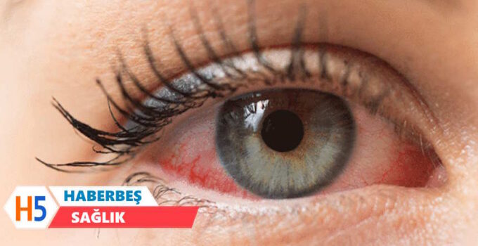 Göz Yanması Neden Olur? Göz Yanmasının Nedenleri ve Korunma Yolları
